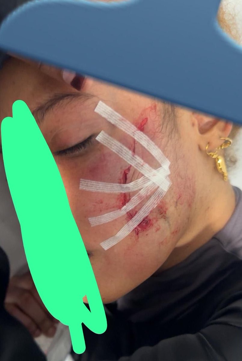 lil_doza's tweet photo. Both were attacked by racists in Ireland.

Both ended up in hospital with lifetime scars.

Both attacks happened in June.

Both are Somali migrants.

Targeting people because they look different to you is a sign of weakness not strength. 

Bigots openly spread a doctrine that led to this kind of attacks, they discuss it online on daily basis “make it hostile for them so they can leave” is the idea. 

We have an obligation for the wellbeing of immigrants in Ireland. Actions speak louder than words.