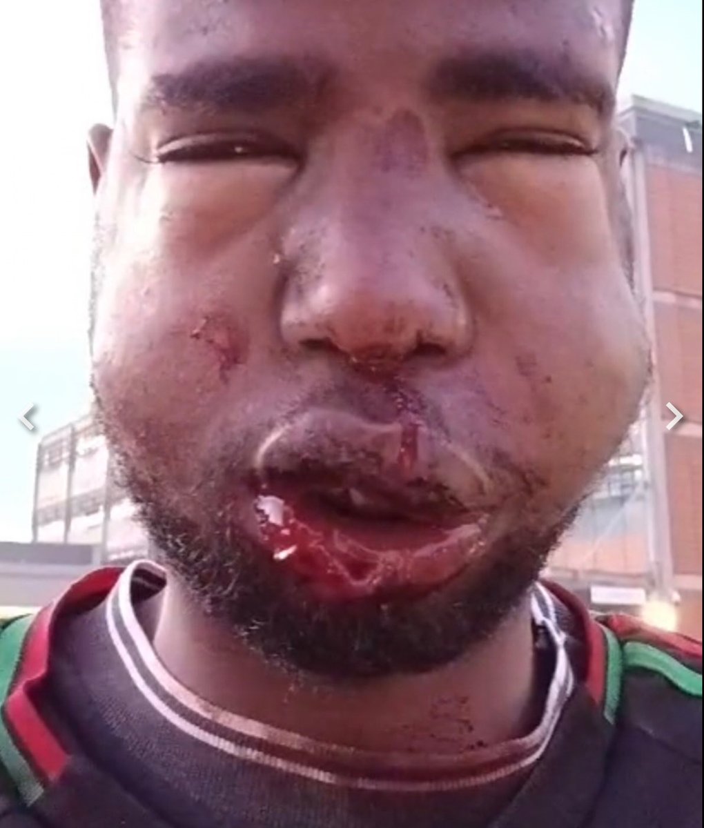 lil_doza's tweet photo. Both were attacked by racists in Ireland.

Both ended up in hospital with lifetime scars.

Both attacks happened in June.

Both are Somali migrants.

Targeting people because they look different to you is a sign of weakness not strength. 

Bigots openly spread a doctrine that led to this kind of attacks, they discuss it online on daily basis “make it hostile for them so they can leave” is the idea. 

We have an obligation for the wellbeing of immigrants in Ireland. Actions speak louder than words.