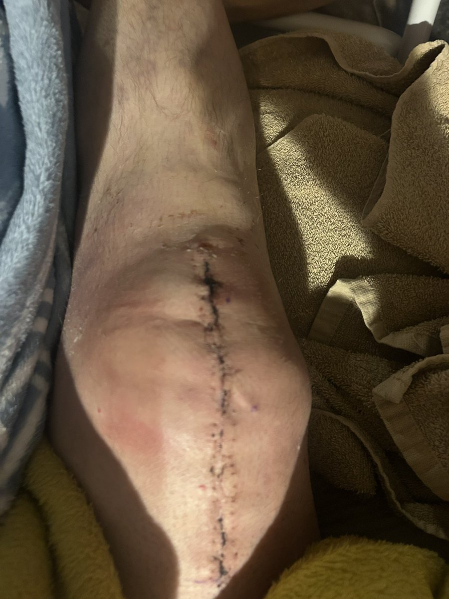 szantom's tweet photo. @TKRanch Just ask my knee. https://t.co/oN8ZKQoSfN
