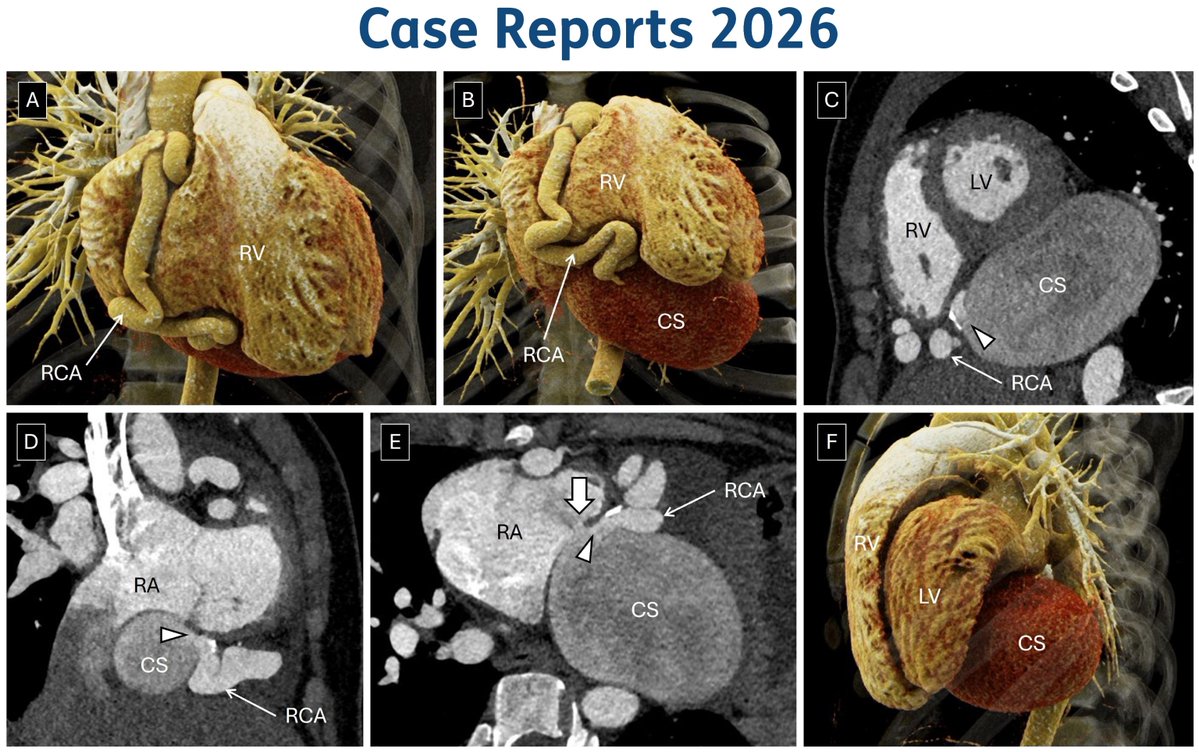 DeBakeyCVedu's tweet photo. Share an interesting case! Submit clinical cases on novel scenarios related to CV. Submit ~1K words w/ images/videos at https://t.co/wQfY09bzc6

Or submit Multimodality Museum Images-see our Special Collections https://t.co/wFlcdPzJGr

#DeBakeyCVJournal @maquinonesmd @NadeenFaza https://t.co/xMOYlTwsJb
