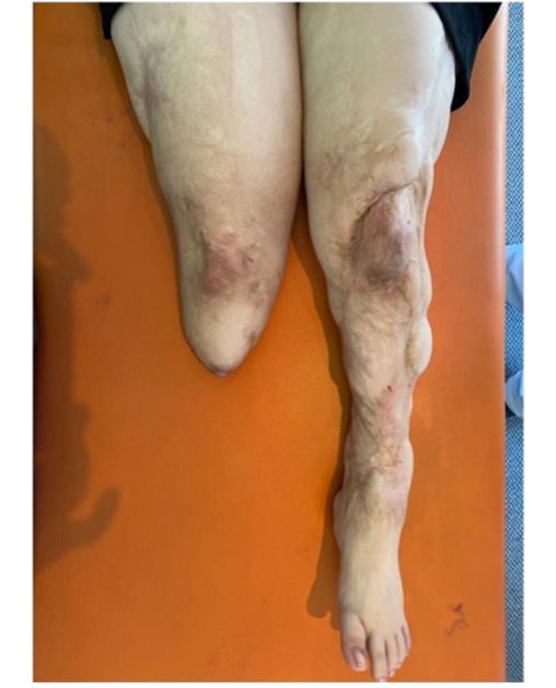 jbjs's tweet photo. "Medial Patellofemoral Ligament Reconstruction for Patellar Instability in a Patient with Below-Knee Amputation" by KavcΔ± et al.
Read the full article π https://t.co/37bcdHQ4jR
#JBJS https://t.co/d9zuGYsRSg