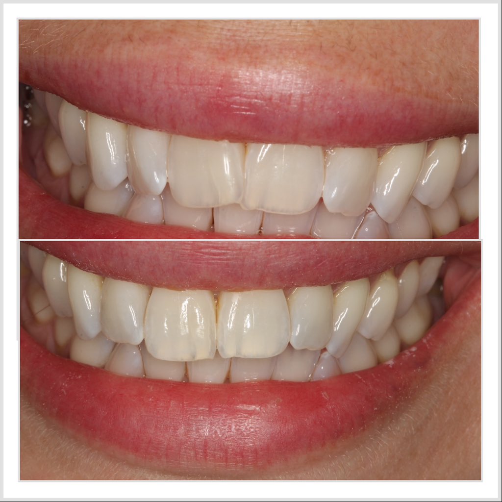 progresdent's tweet photo. Great Social 6 lingual brace case for Friday. Straight front teeth in just over three months. Totally invisible and affordable! Expert treatment by Dr Nissit Patel https://t.co/JIc0woJa1Z