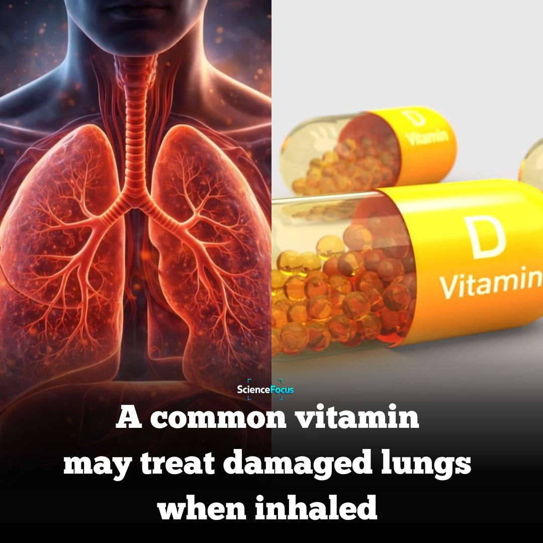 ICDeadPixels's tweet photo. What if repairing damaged lungs was as simple as breathing in a vitamin?

It may sound unbelievable.

But scientists are exploring exactly that.

Researchers have developed an inhalable form of vitamin D that delivers the nutrient directly into the lungs, where it could help reduce inflammation and support the repair of damaged tissue.

Unlike vitamin D tablets, which travel through the entire body, inhaled vitamin D is designed to reach the lungs directly.

That targeted approach could allow higher concentrations to reach injured areas while reducing unwanted effects elsewhere in the body.

Early laboratory studies have shown promising results, suggesting the treatment may help restore normal lung function and reduce the scarring seen in chronic lung diseases.

Scientists believe this approach could one day benefit people with conditions such as COPD, pulmonary fibrosis, or lung damage caused by severe infections.

However, this treatment is still experimental.

Most of the evidence so far comes from preclinical research, and human clinical trials are needed to confirm that it is both safe and effective.

While the findings are encouraging, inhaled vitamin D is not currently an approved treatment for damaged lungs.

Even so, the research highlights how a familiar vitamin could one day become part of an entirely new way to treat serious respiratory diseases.

Sometimes the biggest medical breakthroughs begin with something we've known about for decades.
