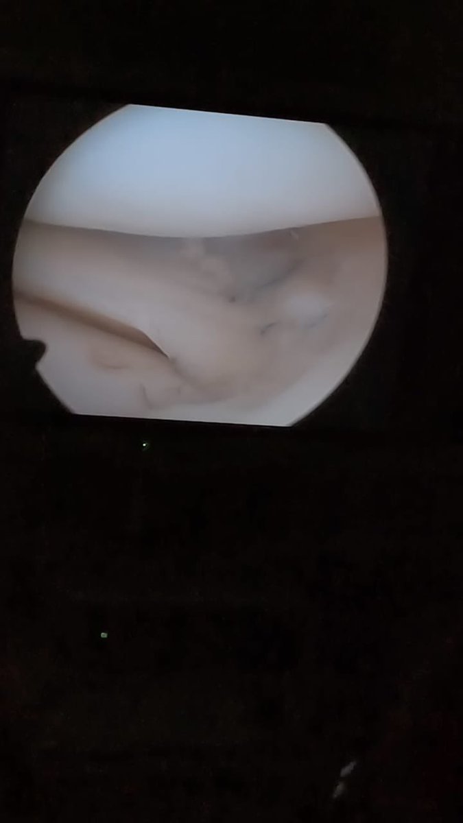 NavarraCamilo's tweet photo. Reparación y rafia meniscal . Safe meniscus https://t.co/byYHV968oL