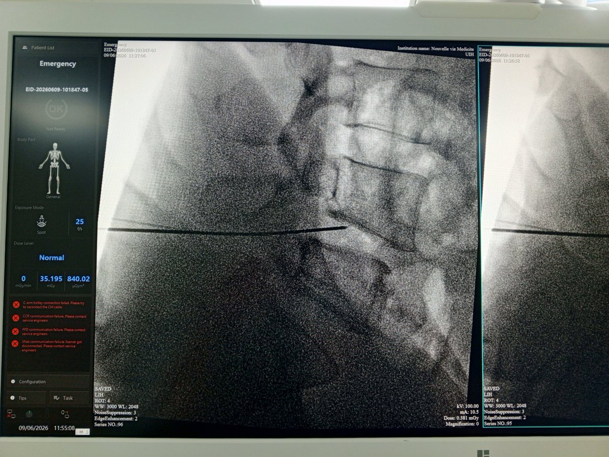 GRNeuroC88's tweet photo. La cirugía percutánea con láser representa una alternativa mínimamente invasiva para pacientes cuidadosamente seleccionados, con menor agresión quirúrgica, recuperación más rápida y excelentes resultados cuando está bien indicada. #Neurocirugía #PLDD #CirugíaDeColumna https://t.co/OlmgwGKPA0