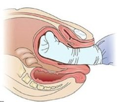 masculinepath04's tweet photo. The average adult human body contains ≈ 5 litres of blood. During late pregnancy, blood flow to the uterus increases to 600 mL per minute.  

If bleeding from the uterus occurs after delivery (postpartum haemorrhage), the body’s entire blood can drain out within 10 minutes. This leaves obstetricians with very little time to intervene and stop the bleeding.  

They therefore act immediately by inserting a fist into the vagina to compress the uterus and stop the bleeding. Otherwise, the mother may bleed to death within minutes.  

Although other treatment modalities are available, manual manipulation of the uterus remains one of the fastest life-saving interventions.