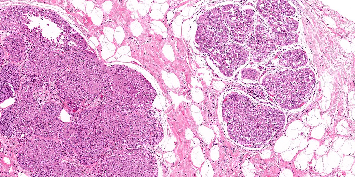 RazaHoda's tweet photo. Whatโs the diagnosis? ๐ฌ
Poll in comments ๐
Answer reveal on Monday ๐ฎ
#PathX #PathTwitter #breastpath https://t.co/BAow5dzMl2