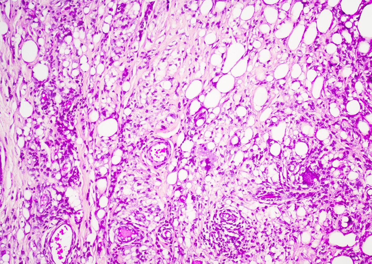 GuannanTiffany's tweet photo. 🧩 Scrotal mass riddle
Is this a neoplasm, or something else?
It has a counterpart lesion in the female breast.
What is your diagnosis?
#DxMindMap #TestisPath #GUPath #Mimicker #PathTwitter @JHUpath https://t.co/iSetzU4whc