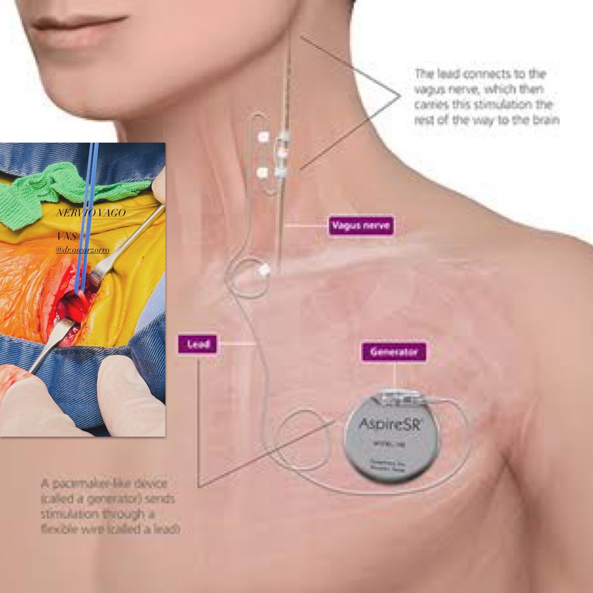 DROSCARZORRO's tweet photo. Dentro de las herramientas de la cirugía de epilepsia para pacientes con epilepsia refractaria está la neuromodulación, y una de ellas es la estimulación del nervio vago, obteniéndose una tasa de mejoría en la calidad de vida y reducción de las crisis que puede variar entre un 50 y 60 % a mediano y largo plazo en adultos y niños, con una tasa baja de complicaciones.