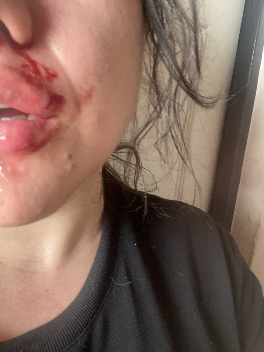 hitm3hardnsoft's tweet photo. 🚨🚨DENUNCIA PÚBLICA: Hago responsable a Daniel Santiago Salazar Solarte de cualquier cosa que me pase. Siento que mi vida corre peligro. Me agredió físicamente con puños en la cabeza y me reventó el labio. Comparto esto para que quede constancia pública. https://t.co/Xadftknszf