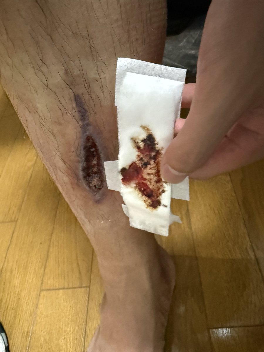 rx_skyfall's tweet photo. 真面目な話で

1年。
ようやく医者からも病院通い終わりで良いと言われたので、完全に復活です🔥

あの日にいたグループは物理的に体に刻み込まれて、一生忘れなくなりました笑

みんな怪我なく遊ぼうねー
それが一番ですからねー https://t.co/6x8T6hLhrS