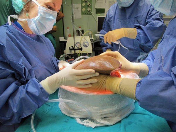 PabloFuente's tweet photo. 💊 MEDICINA: UNA TÉCNICA NO INVASIVA QUE PODRÍA SALVAR MÁS HÍGADOS PARA TRANSPLANTES
Cada día faltan órganos para trasplantes, y evaluar si un hígado donado es viable suele requerir biopsias que solo miran una parte pequeña. Científicos probaron tomografía de coherencia óptica sensible a la polarización (PS-OCT) para escanear toda la superficie de hígados donados humanos descartados. Con aprendizaje automático, midieron grasa, fibrosis, inflamación y necrosis, correlacionando más del 80% con análisis patológicos. Los resultados también se alinearon con el funcionamiento durante perfusión y primeros resultados clínicos post-trasplante. Esto podría reducir descartes innecesarios y aumentar el número de hígados útiles, ayudando a más pacientes con insuficiencia hepática.
#Trasplantes #SaludHepatica
Investigadores de [instituciones como University of Oklahoma y colaboradores], publicado en Science Translational Medicine (equivalente alto). https://t.co/cOiUVL8yV7