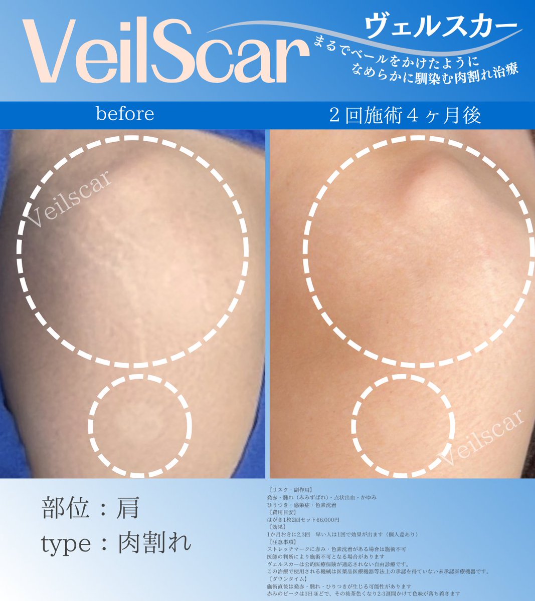Veilscar_nschan's tweet photo. 【言われるたびに嫌だった】
・50代女性
・人に言われるたびに嫌な気持ちになった
・BCG注射後の白斑も気になる

肩はよく目につきやすい場所ですよね。
夏に向けてオシャレを楽しめるようになってほしいな☺️ https://t.co/dRJu0vh8H1