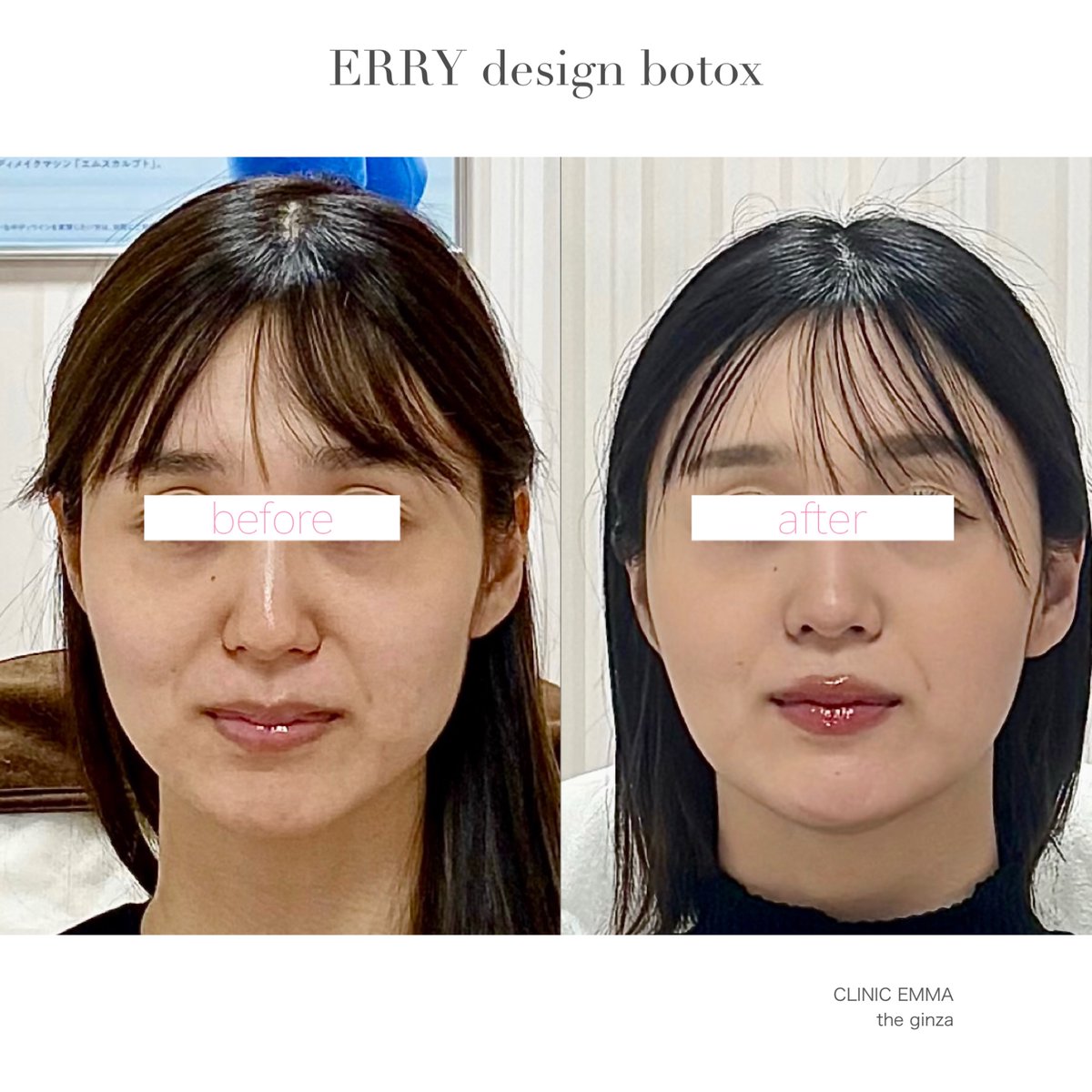 CLINIC_EMMA's tweet photo. 輪郭美人ボトックスを始めてから素敵な出会いがあり💓トントン拍子でお話が進んで✨挙式前の調整にきました🥰
エリー院長が泣いて喜ぶご報告、実はもう5名もおられます😆
恋のキューピッドは可愛い笑顔🤭人生の晴れ舞台も、世界一可愛い自分で迎えましょ💖 https://t.co/fu3uAlrcv2