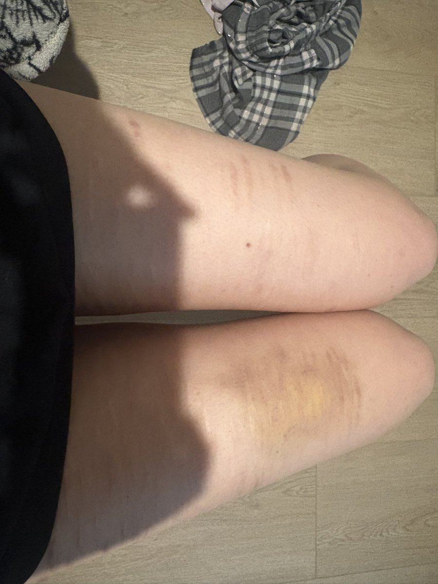 jonastarv3z's tweet photo. #shtwt anyone else self harm by hitting/bruising themselves? https://t.co/wyZnML7dHu