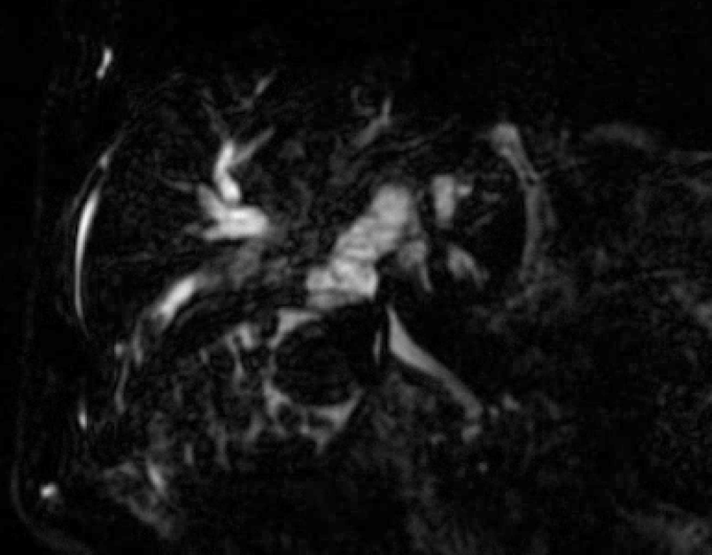 mharisinghani's tweet photo. 3D MRCP showing Mirizzi Syndrome; diagrammatic depiction of anatomy and classification https://t.co/SdJl7gFq1m