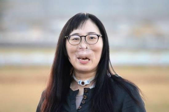 gorilla_buzz7's tweet photo. 母親から「アヒルのガーコ」と呼ばれた女性・河除静香さん（51）の生き様がヤバすぎる。

顔面動静脈奇形という難病を抱え、40回以上の手術を繰り返しながら壮絶で圧倒的に強すぎる。

・中学で「お前に基本的人権はない」とイジメられても学校を休まないど根性

・就活で「見た目で採用できない」と言われても「ブライダルがダメなら葬儀だ！」と即ピボット

・面接官の残酷な言葉すら「傷つかないための親切心だった」と受け止める器の大きさ

・嗅覚を失っても「一生、我が子の匂いが嗅げない」ことを一番の悲しみと言う深い愛情

ルッキズムが叫ばれる今、彼女の「底なしの生命力」の前では言い訳ができない。
もし自分が同じ立場だったら、ここまで強く生きられるか…？

皆はどう感じた？