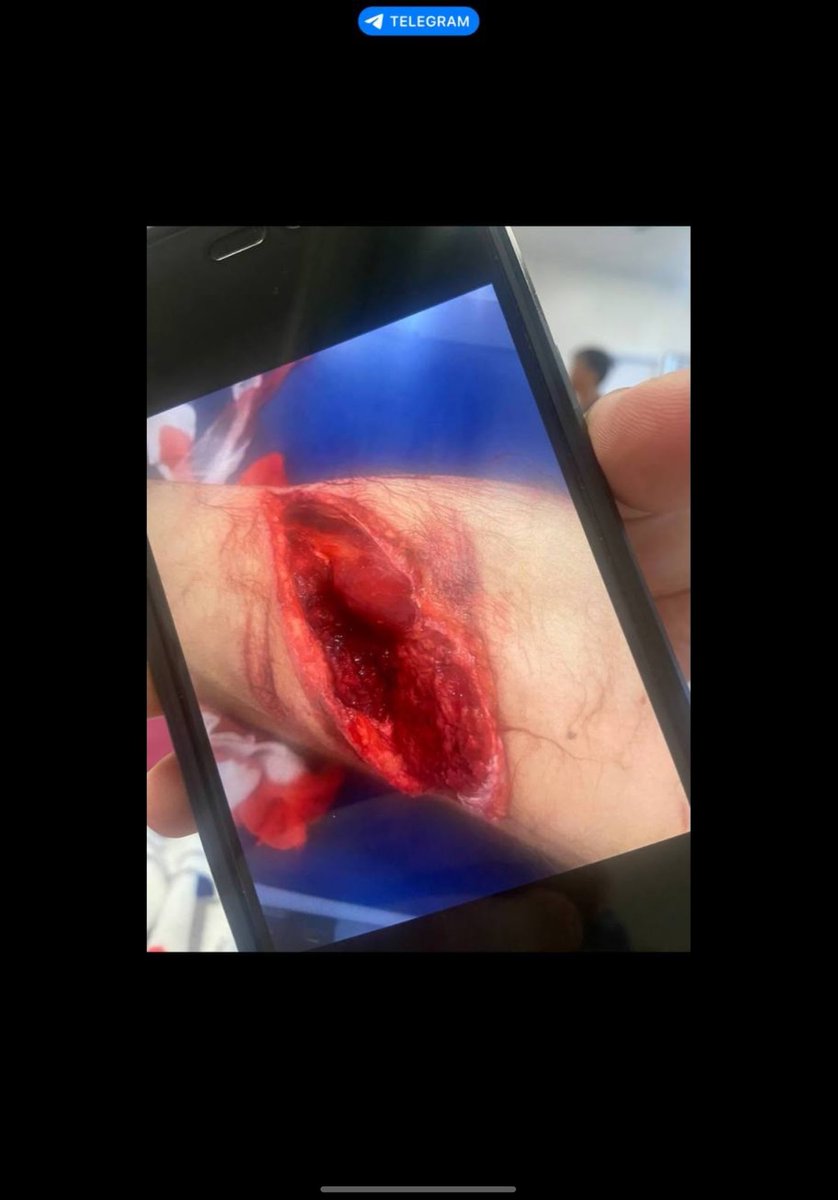 BossDogNFT1's tweet photo. @blknoiz06 Bro please help me with an airdrop so I can get ACL surgery in Cambodia, I’ll prove to you this is really me, I had a bad motorbike accident over a year ago and still cannot walk properly. https://t.co/5dqdLkoTr0