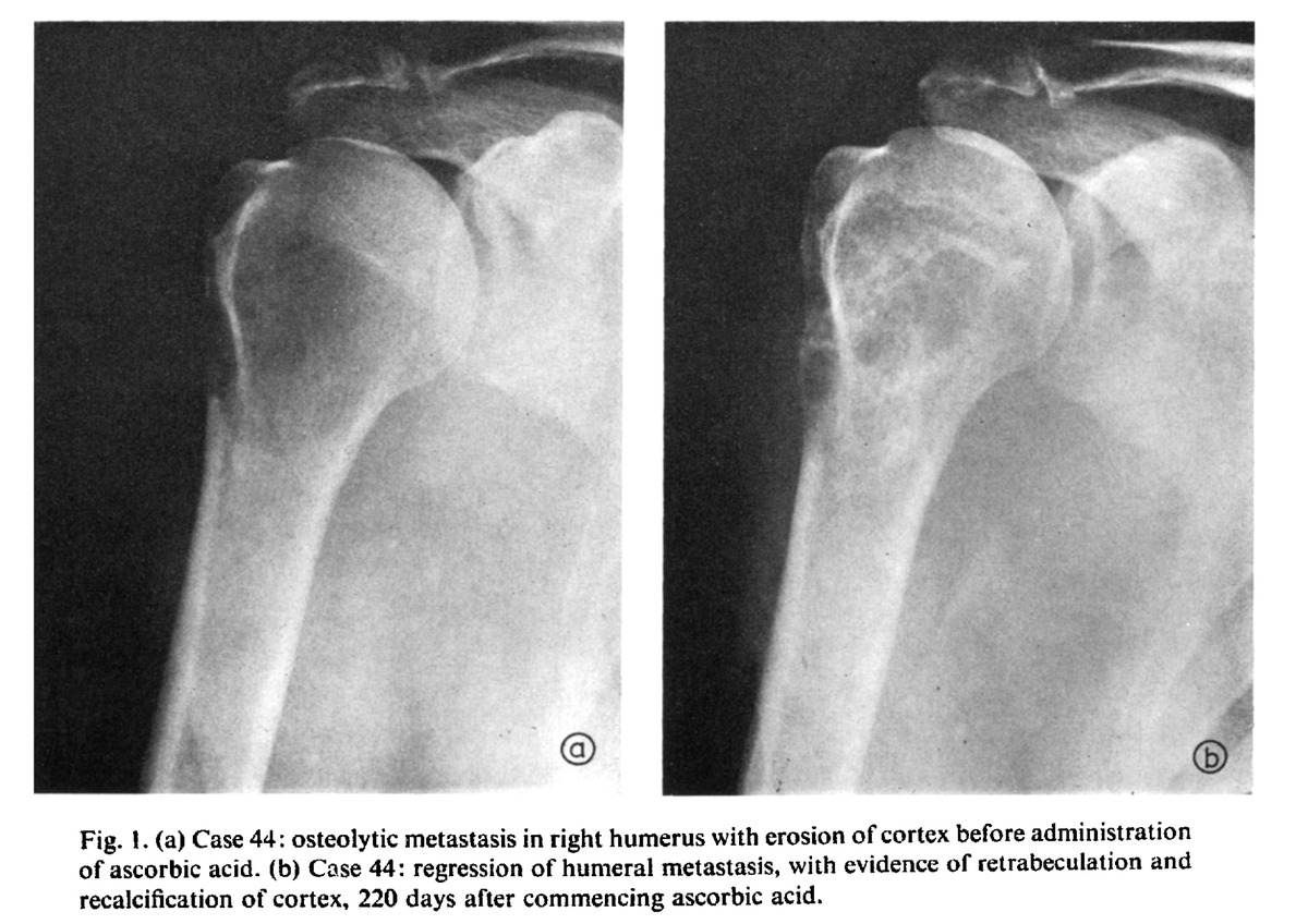 Ivermectinkart's tweet photo. Vitamin C megadosing can halt and even reverse late stage, "incurable" cancers.

Patients with advanced cancer took 10g of IV vitamin C a day for 10 days,

then were maintained on 10g / day of oral vitamin C thereafter.

Here's one example of the power of high dose vitamin C.

This patient had advanced cancer which spread to his bones.

You can see in the X-Ray on the left (prior) how the bone was getting eaten up by the tumor.

After using vitamin C, the bone regenerated, and the patient reported clinical / biochemical remission for months.

◇ Promotes oxidative stress (selectively)
◇ Activates p53
◇ HIF1α decrease
◇ Promotes DNA demethylation
◇ Immune killing / differentiation