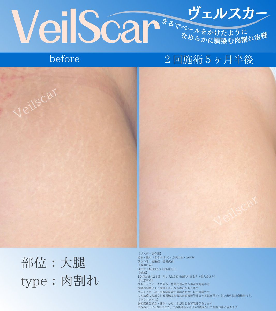Veilscar_nschan's tweet photo. 【全体的にあるけれど…】
・20代女性
・中〜高校生くらいの時にできた
・下半身（全体的）に肉割れあり

たくさん来院して施術部位増やし、麻酔も使用せず治療がんばりました。
目立たなくなって、自信をつけてくれているといいな🎵 https://t.co/0AdLZqZJ1o