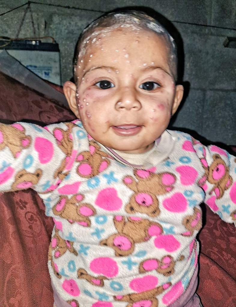 mahmoud60013's tweet photo. STOP Tasneem's pain intensifies with each passing day. The skin disease has spread, covering larger portions of her small body, reaching her face and eyes. Her eyes are swollen and red, and every tear she sheds only increases her pain and distress. The burning sensation is constant, and the intense itching prevents her from sleeping or finding any comfort. Doctors have confirmed that her condition requires urgent treatment. 
https://t.co/Q1uKW9AYsL
Please help us, even with a prayer in the Comments.