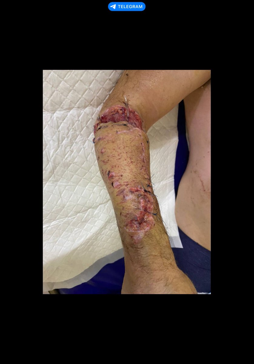 BossDogNFT1's tweet photo. @WhaleScan Please bro so I can get ACL surgery in Cambodia 

Fr3LPsrsiFNmuPNboyZ1tkWv7Rew2V2ymCY3FyD5cVH1

I’ll prove this is true https://t.co/mHK00G2Skz