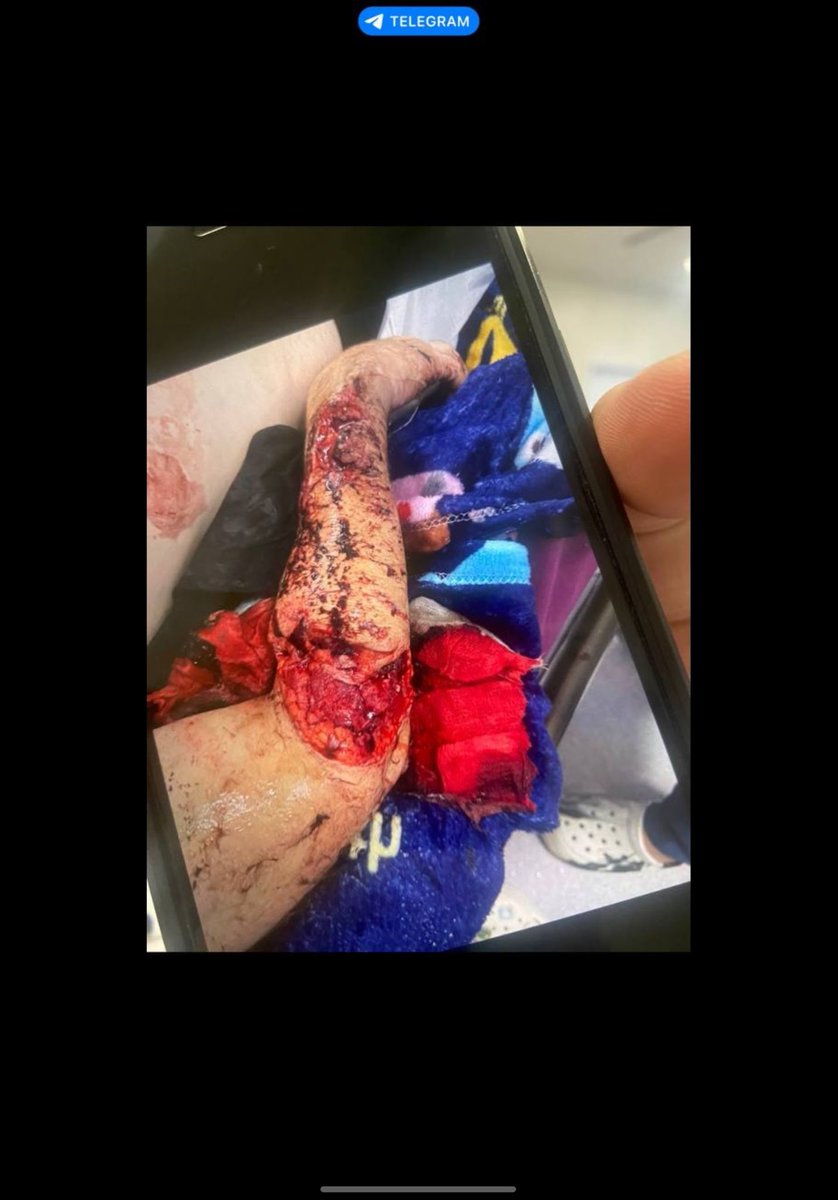 BossDogNFT1's tweet photo. @WhaleScan Please bro so I can get ACL surgery in Cambodia 

Fr3LPsrsiFNmuPNboyZ1tkWv7Rew2V2ymCY3FyD5cVH1

I’ll prove this is true https://t.co/mHK00G2Skz