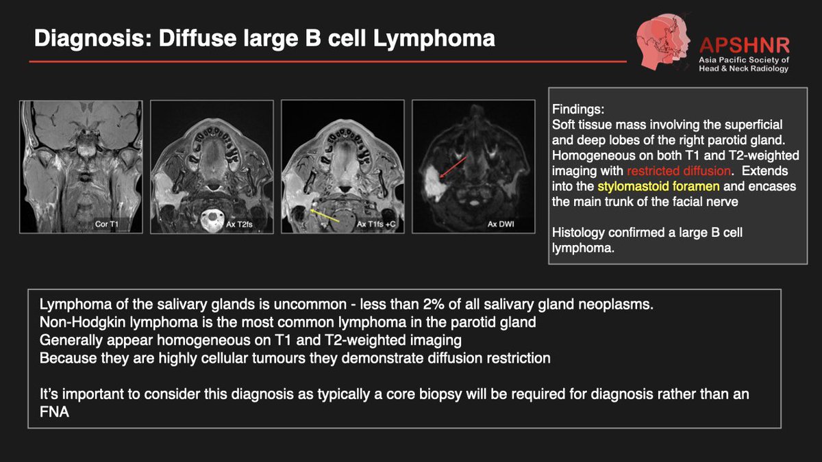 APSHNRORG's tweet photo. APSHNR Case of the Week – Answer Revealed (Swipe to Reveal ➡️)

Thank you to everyone who participated in our very first APSHNR Case of the Week! We enjoyed seeing your differential diagnoses and the discussion.

#APSHNR #CaseOfTheWeek #HeadAndNeckRadiology https://t.co/PzQ4ZrlgKf