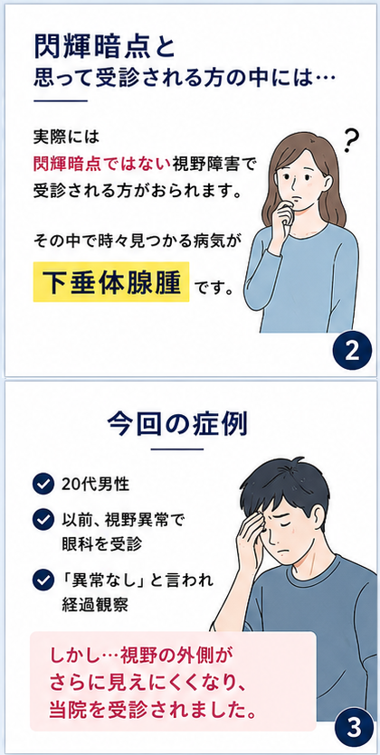 ymc3838's tweet photo. 閃輝暗点だと思ったら…
実は下垂体腺腫でした。

眼科では「異常なし」と言われた
20代男性の症例です　① https://t.co/AqQxmfHCHd
