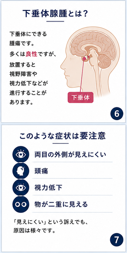 ymc3838's tweet photo. 閃輝暗点だと思ったら…
実は下垂体腺腫でした。

眼科では「異常なし」と言われた
20代男性の症例です　① https://t.co/AqQxmfHCHd