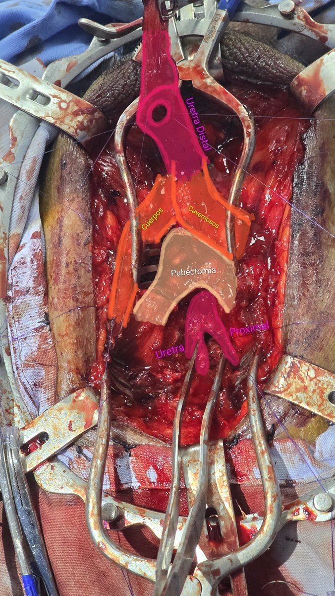 marquina_cruz's tweet photo. Webster Step 3a Posterior Anastomotic Urethroplasty secondary to Pelvic Fracture // Plastia de Uretra Posterior Termino-Terminal Webster 3a secundaria a Fractura de Pelvis https://t.co/uQmPKB7E7G