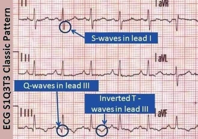 AB_drmd's tweet photo. تخيل إنك قاعد في مناوبة طوارئ وكل شي هادي، وفجأة يدخل مريض عمره 35 سنة وهو يلهث وما يقدر ياخذ نفسه تمام. يقول لك: "دكتور، فجأة حسيت كأني بأغرق وما أقدر أتنفس!"
. وأنت أول ما تفكر فيه تقول: "هذا أكيد Pulmonary Embolism!". لكن المشكلة: كيف تعرف؟! هنا يجي دور ECG والـ S1Q3T3!.

إيش يعني S1Q3T3؟
هذا نمط يظهر في تخطيط القلب (ECG) في حوالي 20% من مرضى Pulmonary Embolism (PE). النمط هذا يشير إلى ضغط عالي في البطين الأيمن (Right Ventricle).

وش يتضمن؟
1. S wave في Lead I:
- خط موجي كبير غريب طالع تحت.
- السبب؟ الضغط في البطين الأيمن يغير شكل الكهرباء اللي تمر بالقلب.
2. Q wave في Lead III:
- خط صغير نازل في البداية، اللي هو الـQ.
- سببه؟ نفس الشيء، الضغط يؤثر على البطين الأيمن.
3. Inverted T wave في Lead III:
- الـT اللي مفروض تطلع فوق، قلبت وصارت تحت.
- ليش؟ بسبب الإجهاد الكبير اللي على البطين الأيمن.

إيش ممكن يساعدك مع S1Q3T3؟
إذا شفت النمط هذا مع الأعراض اللي زي:
- Sinus tachycardia (سرعة في ضربات القلب).
- الرئتين تكون صافية (ما في كتمة أو سوائل).
- Low SPO2 (نقص الأكسجين).
تأكد إن المريض غالباً عنده Pulmonary Embolism، بس لازم تعمل فحوصات إضافية للتأكيد.

أعراض إضافية ممكن تشوفها:
- Transient RBBB: حظر مؤقت في البطين الأيمن.
- Right axis deviation: محور القلب ينحرف لليمين.
- Pulmonary strain patterns: إجهاد واضح على الرئتين بسبب الضغط.
- New onset a-fib or a-flutter: ظهور جديد للرجفان الأذيني.

ليش يصير كذا؟
في الوضع الطبيعي، البطين الأيمن (RV) والبطين الأيسر (LV) يشتغلون في انسجام تام. لما يصير Pulmonary Embolism، الجلطة تسد الأوعية الدموية في الرئة، فيرتفع الضغط في البطين الأيمن. النتيجة؟
- البطين الأيمن يتوسع (Dilated RV) ويحاول يضخ، لكنه يعاني.
- التضخم يضغط على القلب ويأثر على البطين الأيسر، فيصير القلب كله "مضغوط"، ويطلع نمط S1Q3T3.