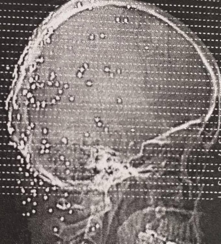 AgeofPahlavi's tweet photo. بیش از ۲۷۰ ساچمه از کمر گردن و پیشانی این فرد در اورده شده
اما یکی از ساچمه ها وارد ناحیه بسیار حساس ساقه مغزی شده
بیش از ۳ میلیارد تومن هزینه جراحی و ریسک بالای مرگ 
در این دو هفته من به اندازه دو سال پیر شدم برای نجات دادن این فرد
و این سندی از جنایت جمهوری اسلامیست
#جاویدشاه https://t.co/MZM5td9v4E