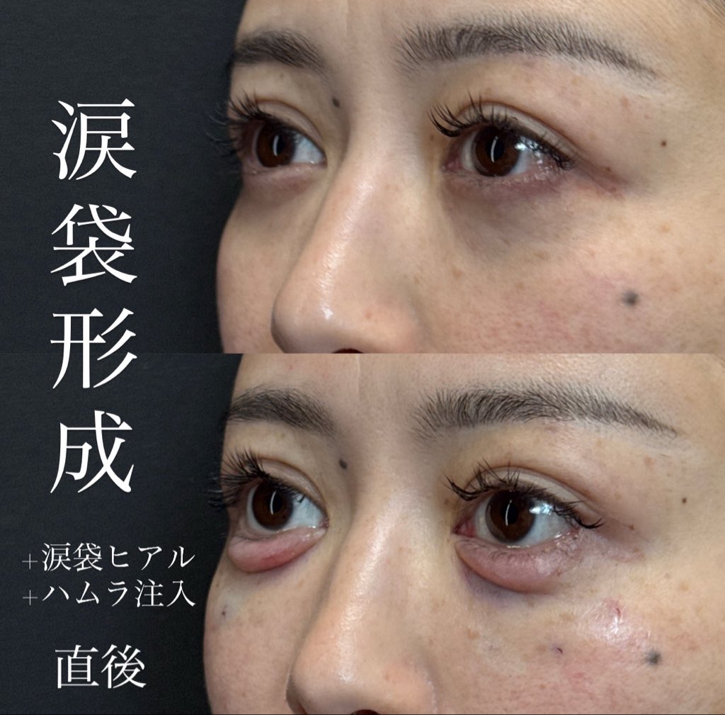 norimoto24's tweet photo. 涙袋を作るなら→涙袋形成一択

涙袋を作るなら→涙袋形成一択

涙袋を作るなら→涙袋形成一択

涙袋を作るなら→涙袋形成一択

基本的にヒアル併用は無くて良いだが

今回は皮膚,筋肉組織が痩せている為
ヒアル注入併用しました
完成後ボリュームが多ければヒアルを溶かして調整していきます https://t.co/SRgwDSlovm