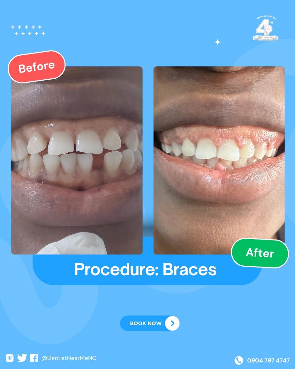 DentistNearMeNG's tweet photo. 4 years ago, we set out to help more Nigerians smile with confidence. Today, that mission is stronger than ever. 💙 https://t.co/rZSvJ0Pxq1