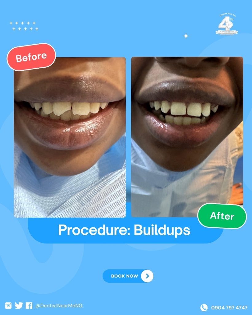 DentistNearMeNG's tweet photo. Throughout July, we’re celebrating 4 Years of Confident Smiles—four years of transforming smiles, restoring confidence, and earning the trust of thousands of patients.

This is more than an anniversary. It’s a celebration of every smile we’ve been privileged to be part of. https://t.co/9Ljy7OJN17