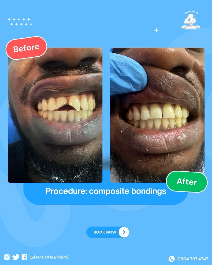 DentistNearMeNG's tweet photo. Throughout July, we’re celebrating 4 Years of Confident Smiles—four years of transforming smiles, restoring confidence, and earning the trust of thousands of patients.

This is more than an anniversary. It’s a celebration of every smile we’ve been privileged to be part of. https://t.co/9Ljy7OJN17