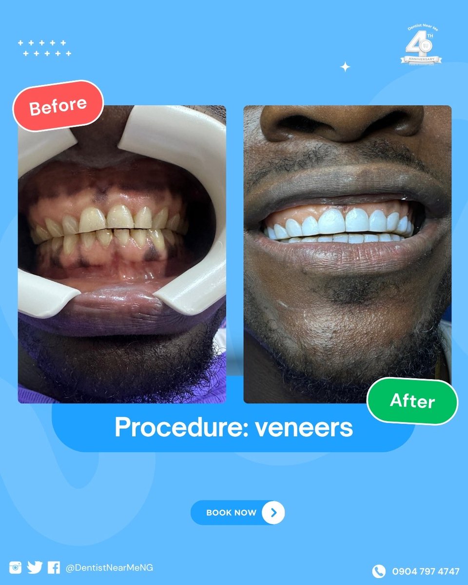 DentistNearMeNG's tweet photo. Swipe through some of the moments that shaped our journey… and thank you for being part of our story.

Here’s to the next chapter. 🥂

#DentistNearMeNG #4YearsOfConfidentSmiles #SmileWithConfidence #DentalCare #AnniversaryMonth https://t.co/1BcfwZPHyz