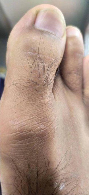 stoicmen_'s tweet photo. Hair on your toes: a small clue about your metabolic and cardiovascular health.

It may seem like an insignificant detail, but clinically it reveals crucial information about how your body is functioning on the inside.

If you don't have hair on your feet, this is what your body is trying to tell you: 🧵