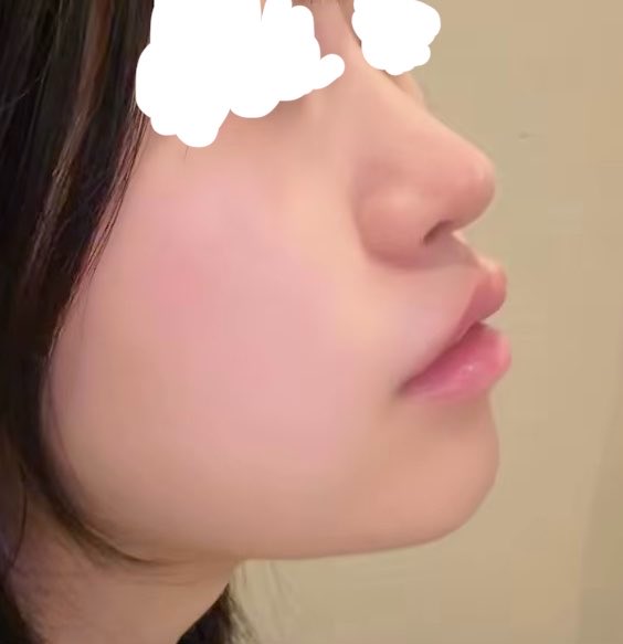 hamumi_desu's tweet photo. バッカル殺したらだいぶ顔面マシになる気がするんだ㌔㌔㌔ https://t.co/FnMWPwk6KA