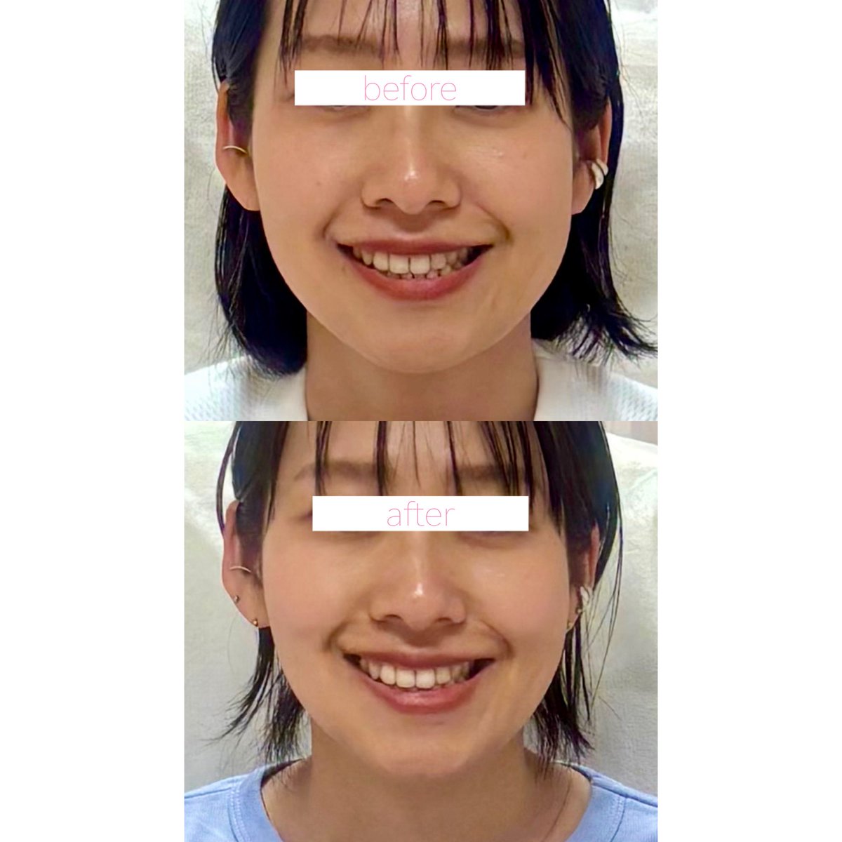 dr_erry_emma's tweet photo. お悩み部位だけではなく
全体の調和もきれいになるように

エラ小さく
ほうれい線浅く

プラス
笑顔も可愛く🩷

#輪郭美人ボトックス https://t.co/ZmoyY9wSms