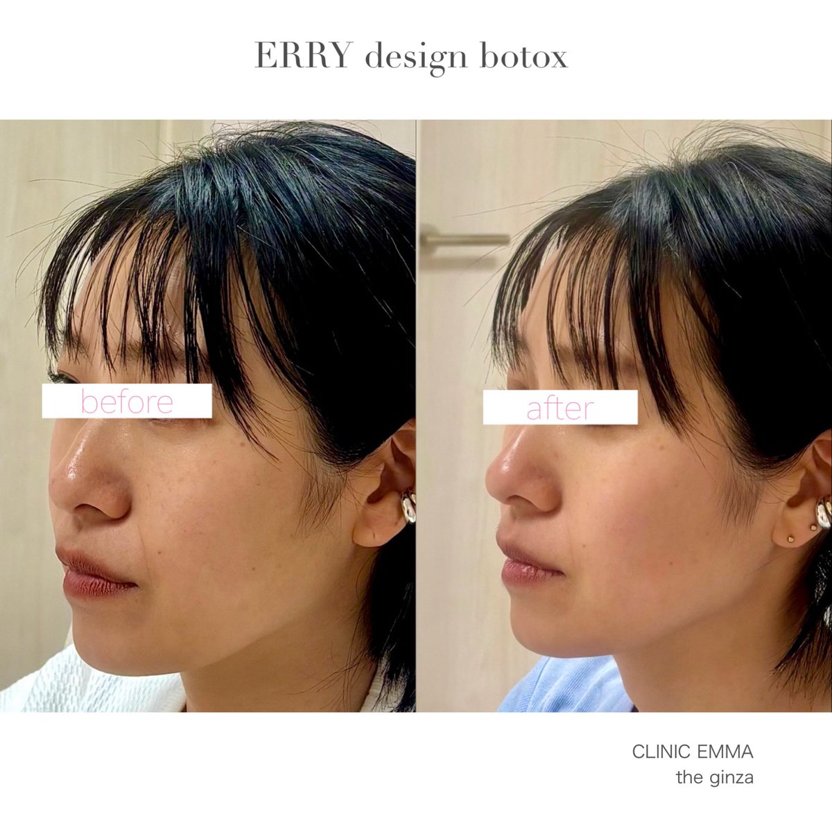dr_erry_emma's tweet photo. お悩み部位だけではなく
全体の調和もきれいになるように

エラ小さく
ほうれい線浅く

プラス
笑顔も可愛く🩷

#輪郭美人ボトックス https://t.co/ZmoyY9wSms