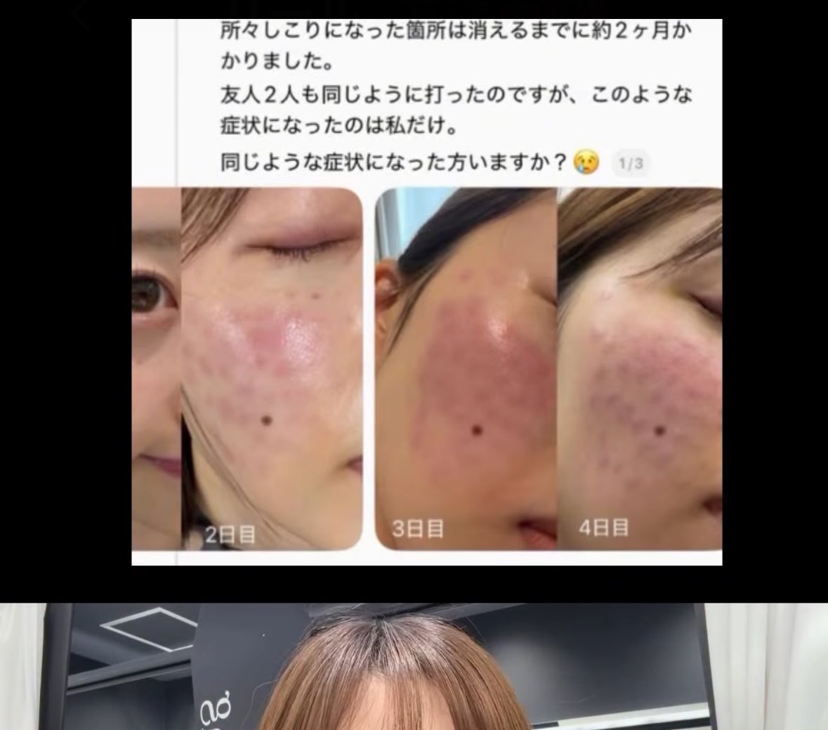 _____biyouaka's tweet photo. え？？？リトゥオの副作用怖すぎ
2月に打ってからまだ治らないらしい https://t.co/ILGEfJfauD