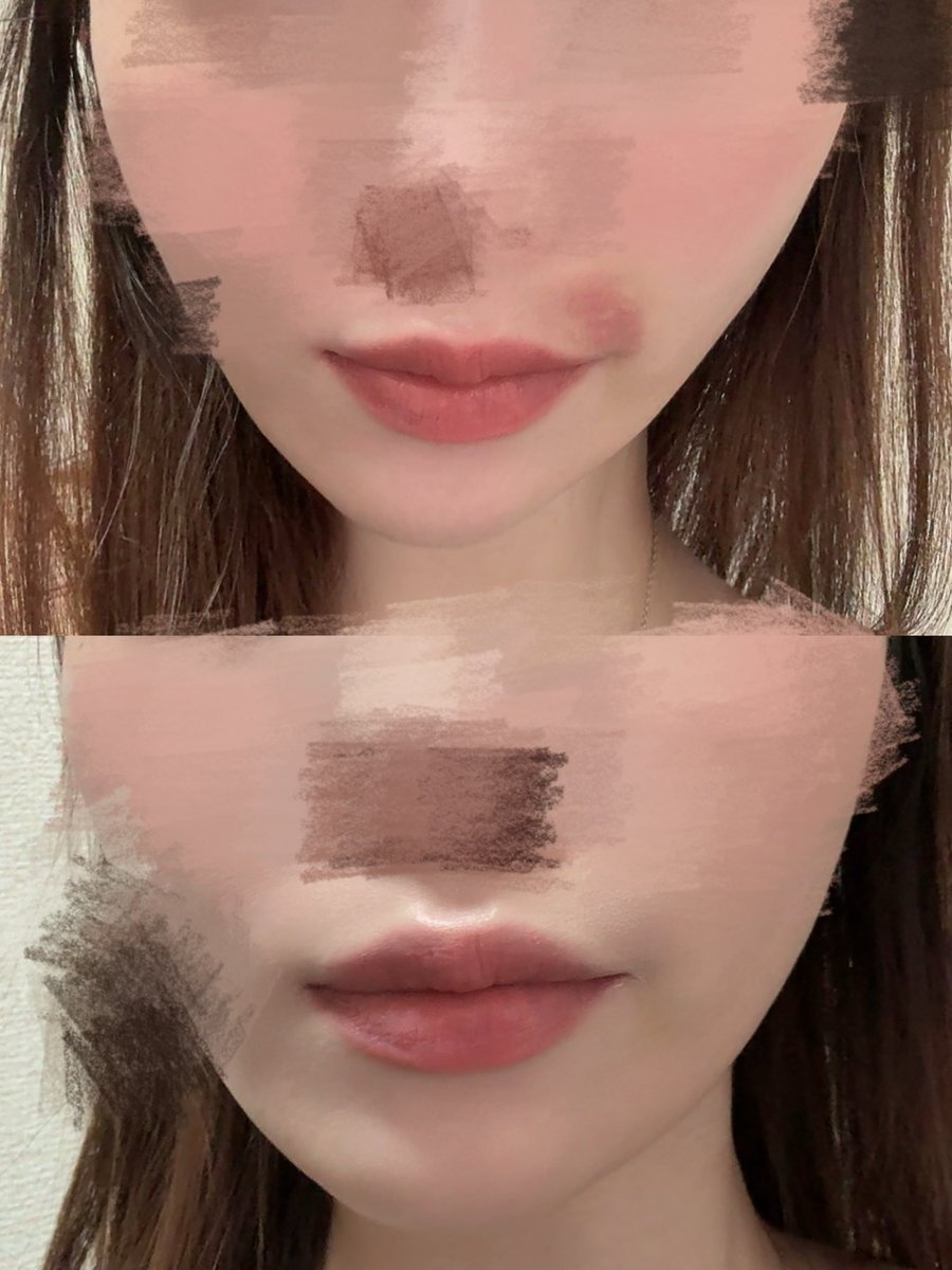 uintoyou's tweet photo. アザできてから何種類も試したコンシーラーがいらないレベル。これで大きなアザがここまで隠れたしバレない😵‍💫🍥 https://t.co/qkRr4NVQTq