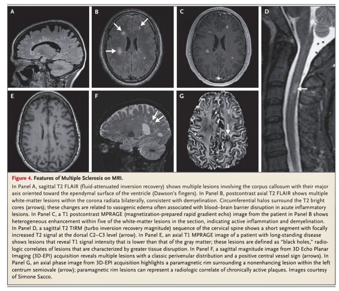 joseramosvivas's tweet photo. REVISIÓN CLAVE  en NEJM sobre el estado actual de la #ESCLEROSISMULTIPLE esclerosis múltiple (EM). 🧠

¿Qué sabemos hoy? 👇

✅ La EM es un trastorno autoinmune crónico del SNC, con inflamación, desmielinización y neurodegeneración.

✅ Su etiología es compleja: incluye predisposición genética, infección por Epstein-Barr y una respuesta inmune con papel destacado de linfocitos B, T y microglía.

✅ Las terapias dirigidas a CD20 han mejorado mucho el manejo de las formas remitentes, pero sigue siendo clave frenar la progresión y promover la reparación de mielina.
🔗👇🏻 https://t.co/GWD43Q2k8X

#EsclerosisMúltiple #Neurología #Neuroinmunología #Medicina #Ciencia #Investigación #NEJM
