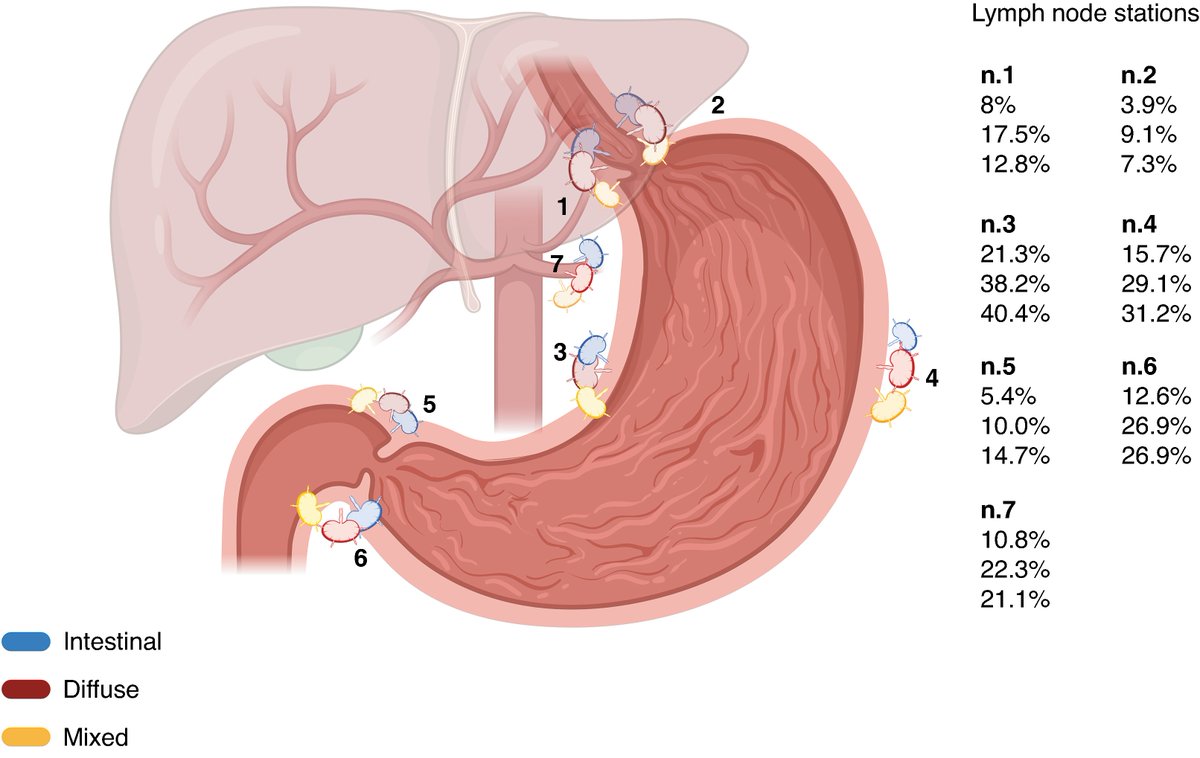 BjsOpen's tweet photo. Pattern of lymph node spread in gastric cancer: Western multicenter retrospective study
➡️https://t.co/jIa9EAPMos

Tumour location determines the anatomical routes of lymph node spread in gastric cancer, whereas histological phenotype and microsatellite status modulate metastatic risk and extent. Diffuse and mixed tumours exhibit a higher nodal burden, whereas MSI cancers show restrained lymphatic dissemination despite advanced local invasion. Integrating biological profiling with anatomically tailored lymphadenectomy may optimize oncological adequacy while avoiding unnecessary nodal dissection.

👏👏👏Francesca Blasa , Giuseppe Verlato , Hidde Overtoom , Martina Hermez Chole , Fabrizio Tedone , Federica Filippini , Markos Despotidis , Evgenia Mela , Tania Triantafyllou , Dimitrios Schizas , Dimitrios Theodorou , Magnus Nilsson , Suzanne S Gisbertz , Maria Bencivenga , Ioannis Rouvelas
#SoMe4Surgery #MedTwitter #SurgEd  #Surgery @BJSAcademy  @BJSurgery #some4UGI #uppergi  #esophagealcancer #gastriccancer    @ISDE_net @Augishealth  @roux_group  @T4UGIS    #ESDE  @young_esde