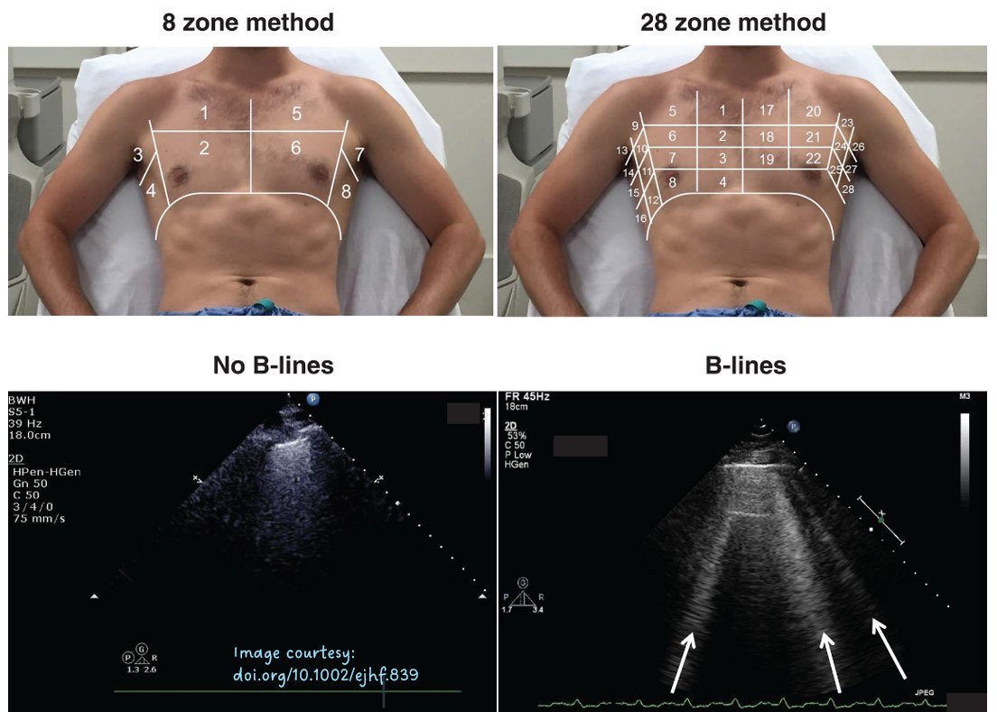 NephroP's tweet photo. Just curious, do you perform 28-zone lung #POCUS in real life (i.e., outside the research setting)?
POLL in thread 👇
#MedEd #Nephrology https://t.co/yqi03NwO2r