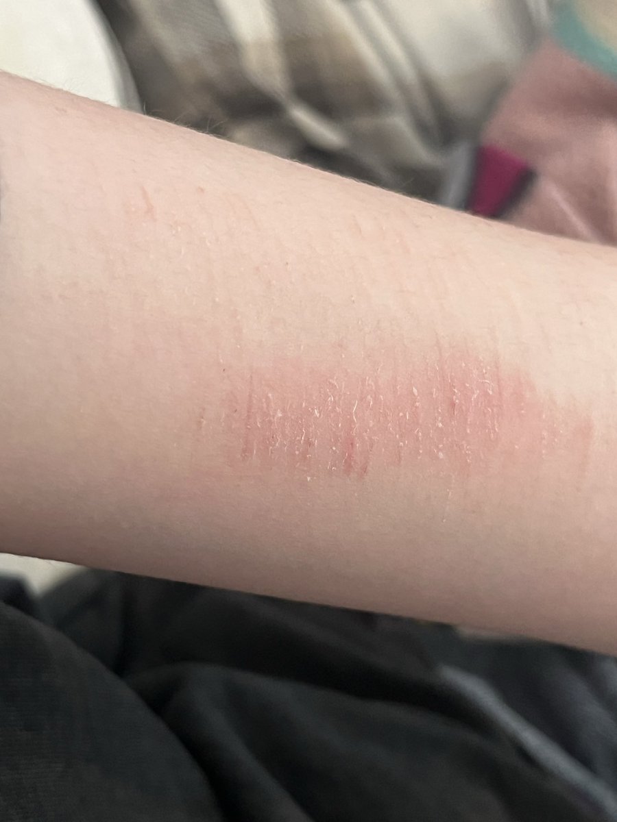 Koharutsb's tweet photo. Is the one that looks open gonna scar? It’s like a month old and looks the same still. Ignore the red I’ve been scratching it 💔 #shedtwt https://t.co/a46nCHvv2e