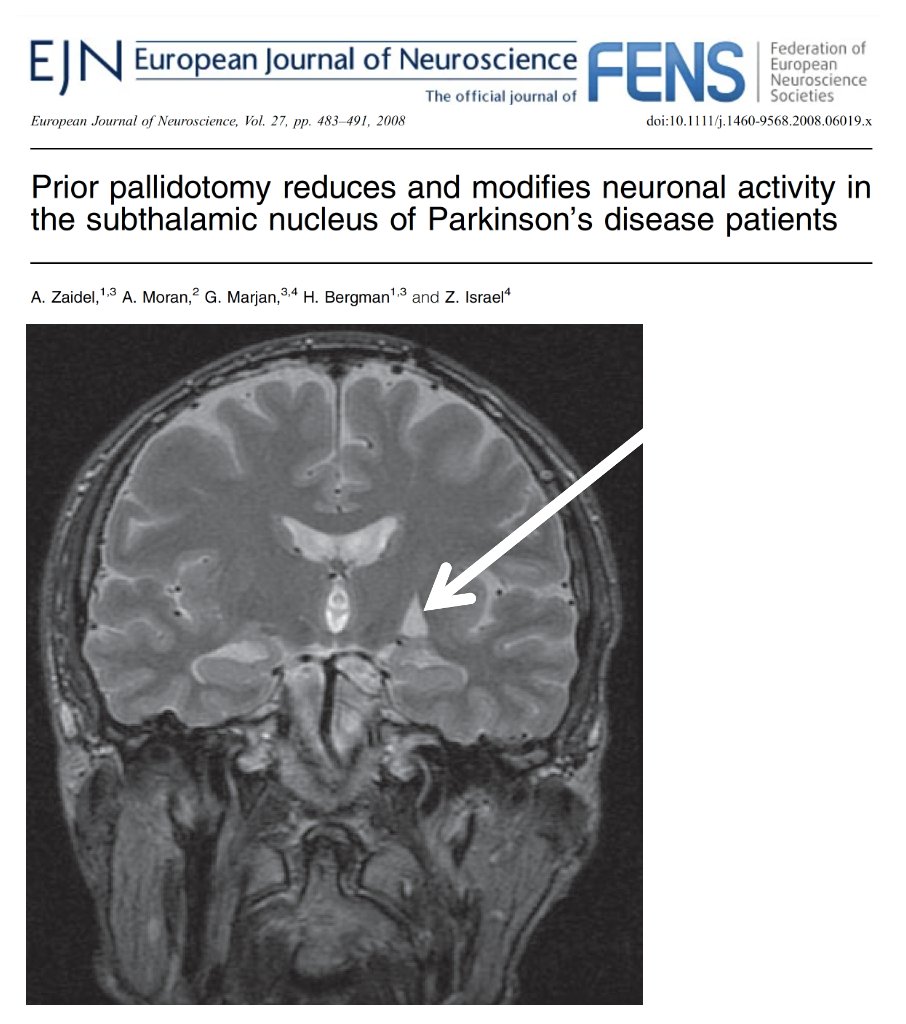 MichaelOkun's tweet photo. Focused ultrasound and pallidotomy: what can lesions teach us that DBS cannot? A lesion means creating a permanent interruption in a brain circuit. Deep brain stimulation (DBS) uses electricity to modulate and reshape abnormal circuits without destroying tissue and importantly it can be adjusted, optimized and reversed if needed. Adam Zaidel and colleagues described in a fascinating paper (2008) in the European Journal of Neuroscience how prior pallidotomy lesions altered the physiology of the subthalamic nucleus (STN) years later in folks living w/ Parkinson's disease. As focused ultrasound lesioning rapidly expands across the globe, this older work may provide important clues into how lesion therapies and DBS differ in their effects on brain circuits. Thanks to my friend Hagai for reminding me about this one.
Key points:
- Prior pallidotomy reduced abnormal activity and oscillations in the STN, suggesting that lesioning one node in a network can reshape activity in distant connected regions.
- The effects were durable and measurable years later, supporting the idea that lesion therapies may permanently reset portions of dysfunctional brain circuitry.
- Despite these changes, STN DBS remained effective in many individuals, highlighting that lesioning and stimulation may improve symptoms through overlapping but distinct mechanisms.
My take: The recent enthusiasm surrounding focused ultrasound is exciting and appropriate. For carefully selected folks, lesion therapies can be transformative. However, focused ultrasound and DBS are fundamentally different interventions and should not be viewed as interchangeable. DBS is more like installing a dimmer switch in a room. You can turn it up, turn it down, move the settings around and adapt as the disease evolves. Focused ultrasound is more like removing a wire from the circuit entirely. Sometimes that may be exactly the right strategy, however, once the wire is cut there is no putting it back.
Here are 5 points that resonated w/ me:
1- Lesions teach us important aspects of neuroscience because they reveal what happens when a node in a brain network is permanently removed.
2- DBS teaches us something different because it allows us to observe and manipulate brain networks in real time.
3- Parkinson's disease and tremor are network disorders and not simply diseases of one structure or one target.
4- The reversibility and programmability of DBS remain major advantages, especially for younger folks and for diseases that evolve over decades.
5- Focused ultrasound and DBS should not compete against one another. The future is matching the right therapy to the right person at the right time in their disease journey. The next decade will likely teach us that lesioning and stimulation are complementary tools. Understanding when to use each may be every bit as important as understanding how they work.
https://t.co/hNd0fLQNYg #parkinson #tremor