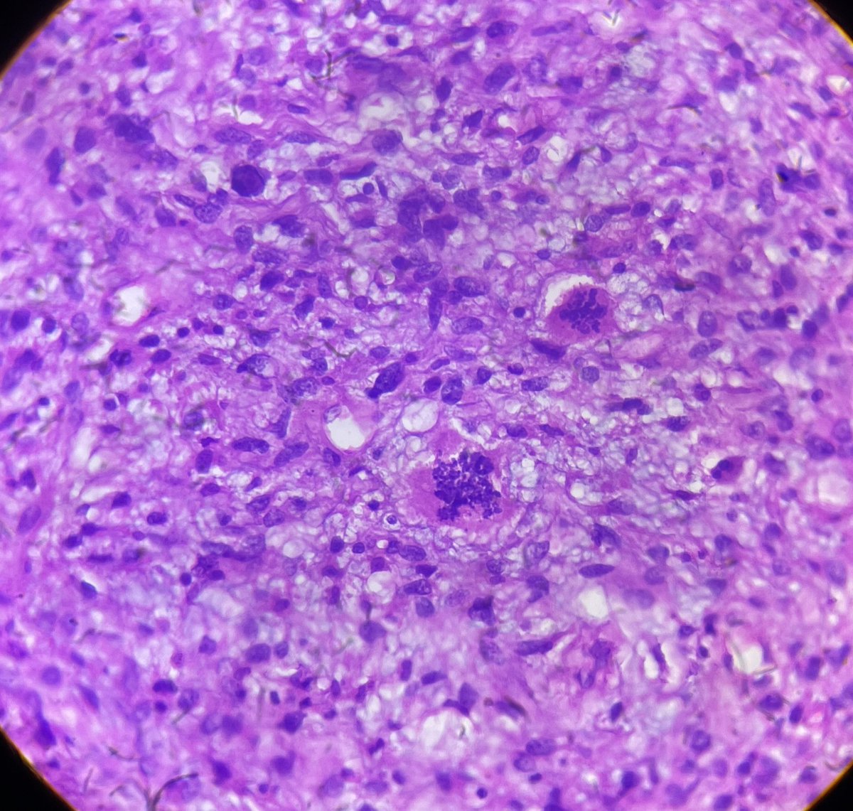 suulynnz's tweet photo. 71 yr old F, recurrent nodules in flexor and extensor aspect of forearm
Dx as Pleomorphic sarcoma in 2021
Your opinion plz
#BSTpath #softtissue #pathX #pathtwitter #pathology #pathresident https://t.co/4IRw18V4XV
